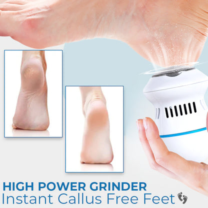 Kalveria® Vacuum Callus Remover