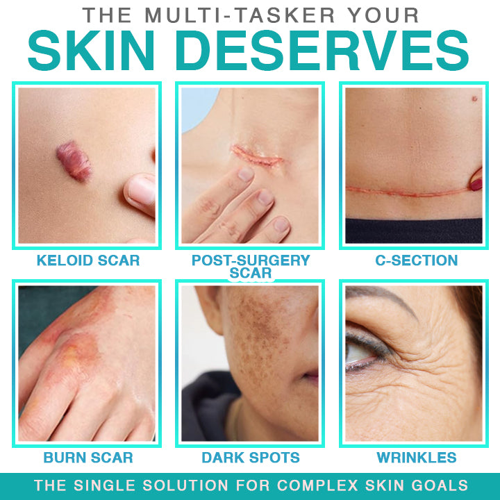 𝘾𝙖𝙧𝙚𝘽𝙧𝙚𝙚𝙯𝙚® Microneedle Scar Care Patch 🇦🇺