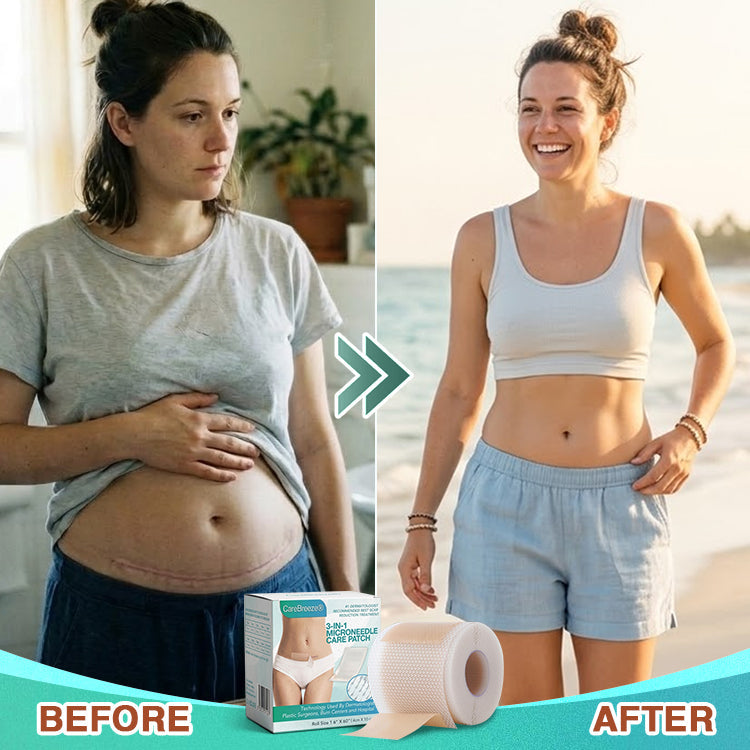 𝘾𝙖𝙧𝙚𝘽𝙧𝙚𝙚𝙯𝙚® Microneedle Scar Care Patch 🇦🇺