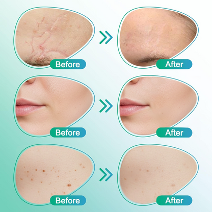 𝘾𝙖𝙧𝙚𝘽𝙧𝙚𝙚𝙯𝙚® Microneedle Scar Care Patch 🇦🇺