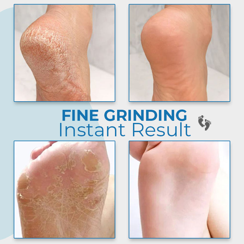 Kalveria® Vacuum Callus Remover